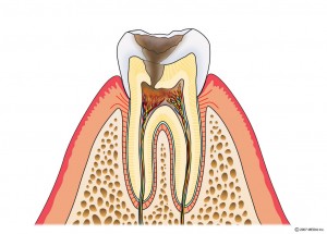 むし歯の進行　C3